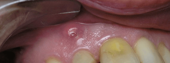 о лечении гранулемы зуба